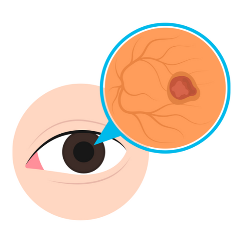 300+ Uveitis Notes